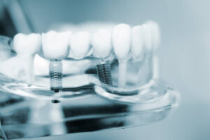 Jacksonville Dental implants