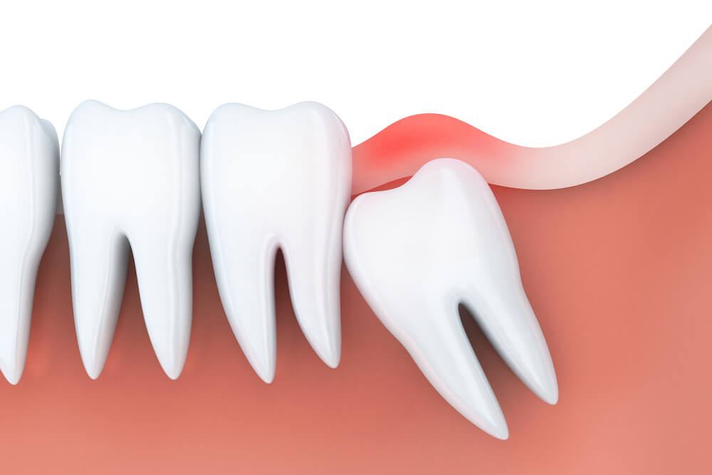 Jacksonville wisdom tooth removal