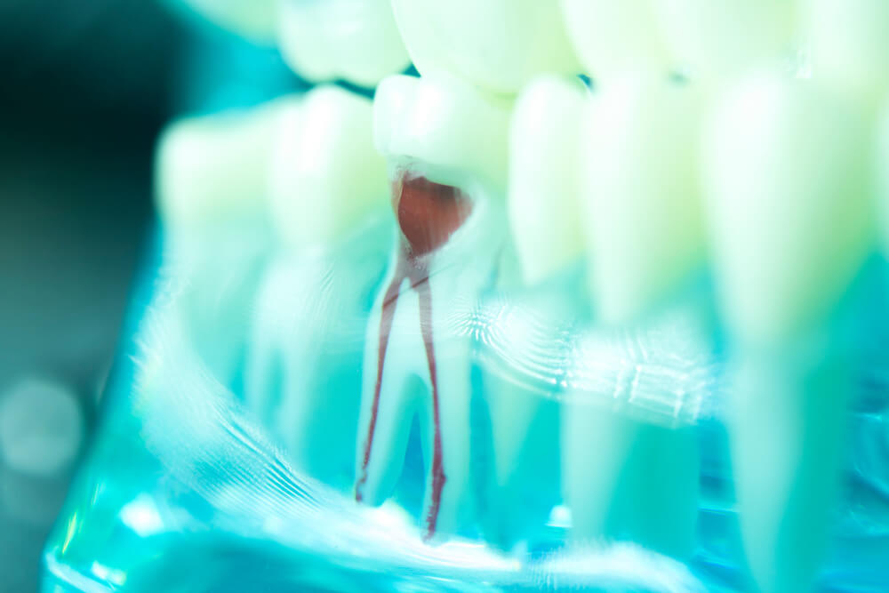root canal in Jacksonville