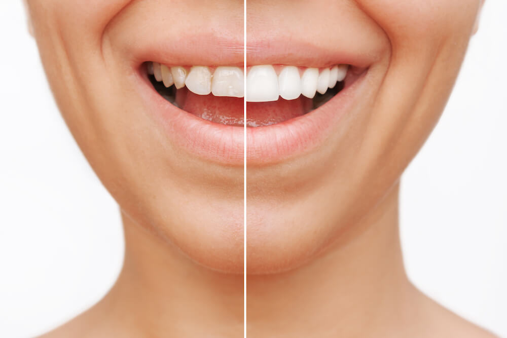 Am I a Good Candidate for Cosmetic Dental Treatments