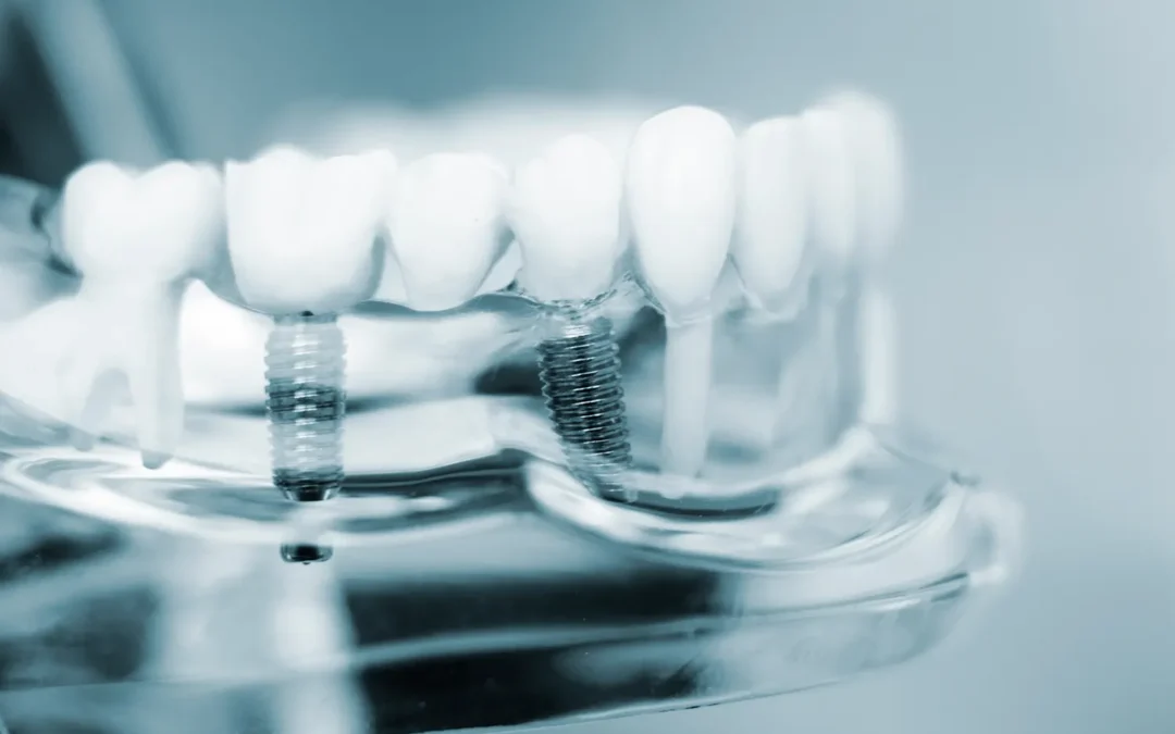 How Painful Are Dental Implants?