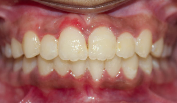 A close-up of a person’s mouth held open with a dental retractor, showing teeth, gums, and aligned dental arches.