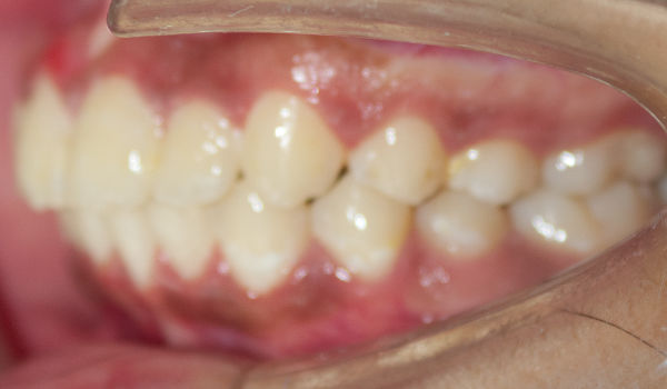 Close-up of a person’s mouth showing teeth and gums, with a dental cheek retractor in place exposing the side view.
