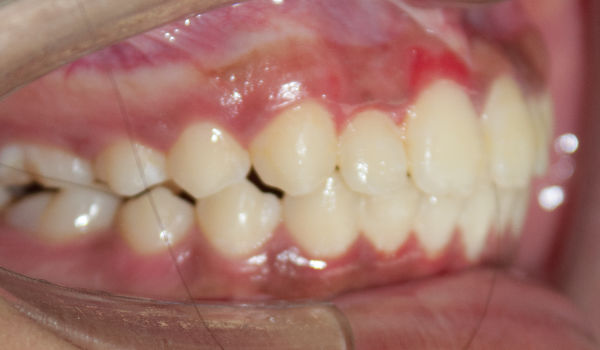 Close-up of a person’s side teeth showing a dental overbite and visible gums, with a cheek retractor holding the mouth open.