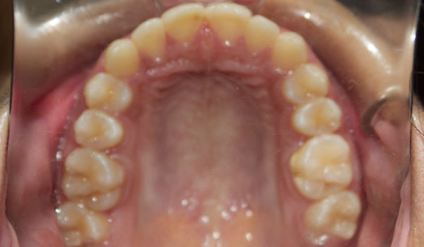 Close-up view of the upper palate and teeth inside an open mouth with a dental cheek retractor in place.