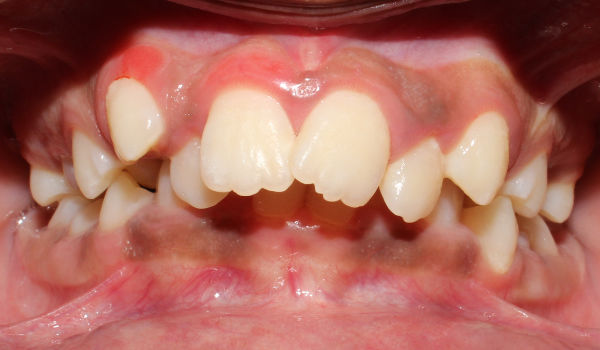 A close-up view of a person’s mouth with dental retractors, showing misaligned teeth and visible gum tissue.