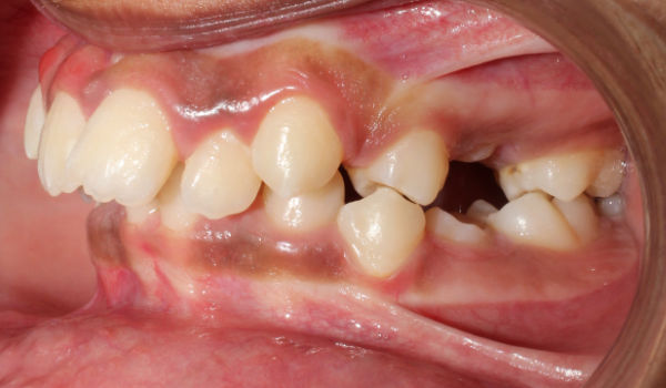Close-up of a person’s mouth showing misaligned teeth, overbite, and dental crowding with a cheek retractor in place.
