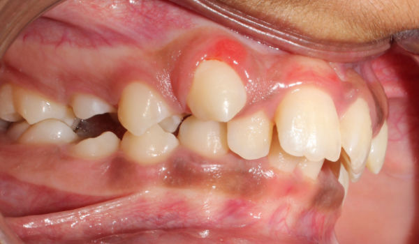 A close-up of a person’s upper teeth and gums shows dental crowding and a red swollen gum above an upper tooth, indicating possible infection or abscess.
