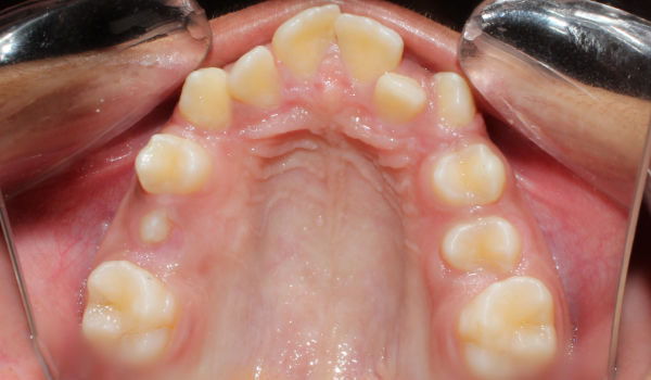Close-up view of an open mouth showing the upper teeth and palate with dental crowding. Mirrors are used to reflect the teeth for better visibility.