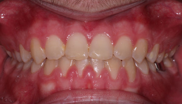 Close-up of a person’s upper and lower teeth with visible gums, showing some crowding and mild discoloration on the teeth.