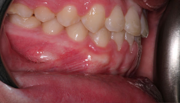 Close-up of a person’s lower and upper teeth showing gums and dental alignment, with cheek retracted for a clear view inside the mouth.