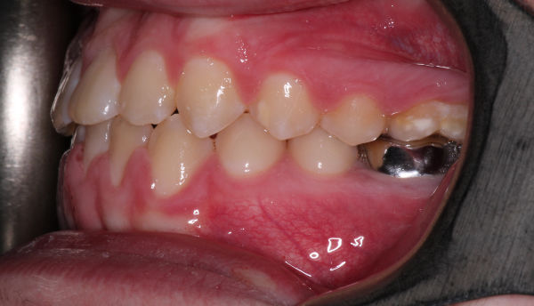Close-up of a person’s teeth showing an orthodontic bite with a metal dental crown or filling on a lower molar.