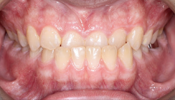 Close-up of a person’s mouth showing upper and lower teeth with mild crowding and visible gums.