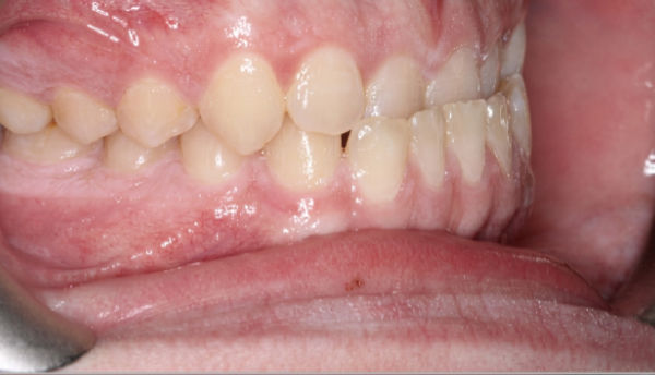 Close-up of a person’s lower jaw showing teeth with slight crowding and a small gap between two front teeth.