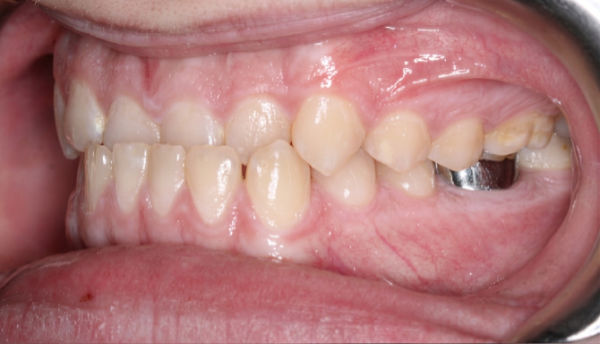 Side view of human mouth showing misaligned teeth and dental crowding, with a metal dental crown visible on a back molar.