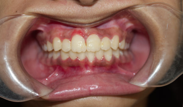 A close-up of a person’s mouth held open with a dental retractor, showing teeth, gums, and aligned dental arches.