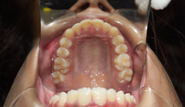 Close-up view of the upper palate and teeth inside an open mouth with a dental cheek retractor in place.