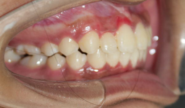 Close-up of a person’s side teeth showing a dental overbite and visible gums, with a cheek retractor holding the mouth open.