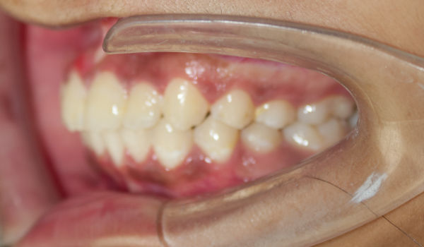 Close-up of a person’s mouth showing teeth and gums, with a dental cheek retractor in place exposing the side view.