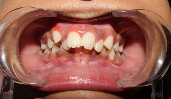A close-up view of a person’s mouth with dental retractors, showing misaligned teeth and visible gum tissue.
