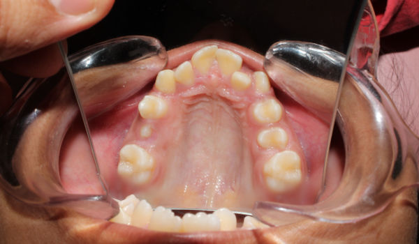 Close-up view of an open mouth showing the upper teeth and palate with dental crowding. Mirrors are used to reflect the teeth for better visibility.