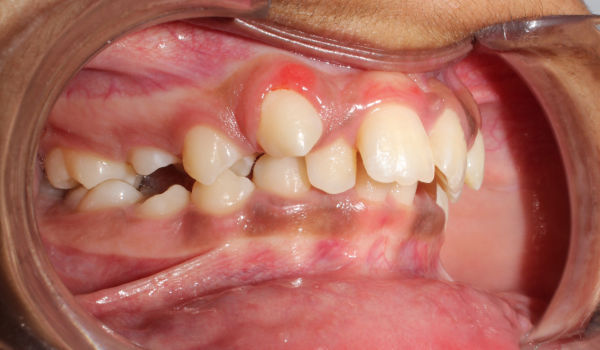 A close-up of a person’s upper teeth and gums shows dental crowding and a red swollen gum above an upper tooth, indicating possible infection or abscess.