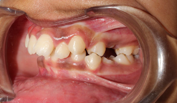 Close-up of a person’s mouth showing misaligned teeth, overbite, and dental crowding with a cheek retractor in place.